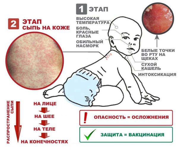 Характерная сыпь для краснухи