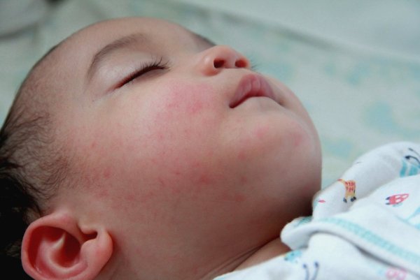 Болезни с высыпанием на теле у ребёнка