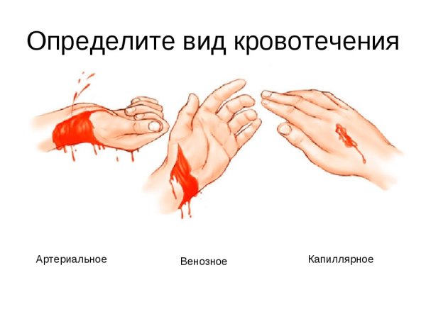 Артериальное венозное и капиллярное кровотечение