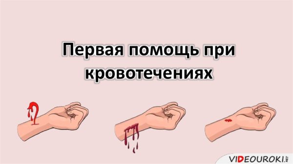 Артериальное и венозное кровотечение оказание первой помощи