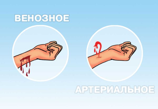 Артериальное кровотечение наложение жгута
