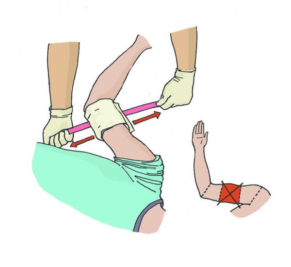 Остановка кровотечения