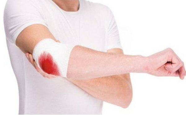 Артериальное венозное и капиллярное кровотечение