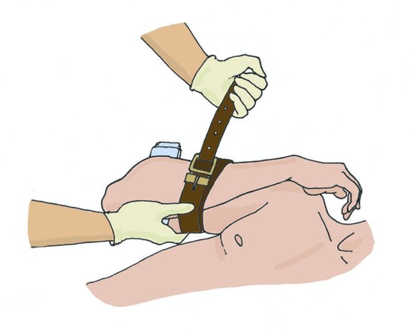 Кровотечение первая помощь