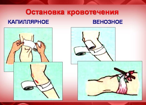 Артериальное кровотечение