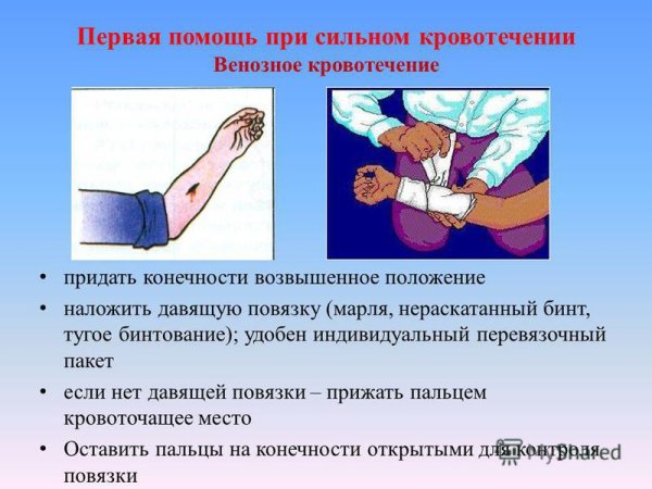 Остановка наружного артериального кровотечения различными методами.