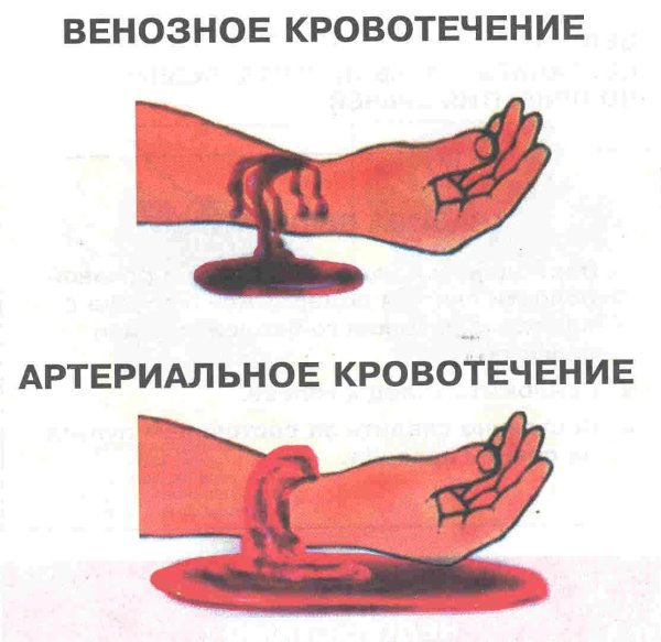Наружное венозное кровотечение