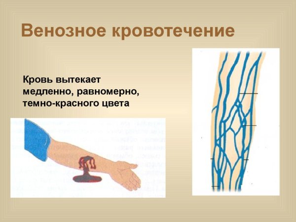Артериальное кровотечение