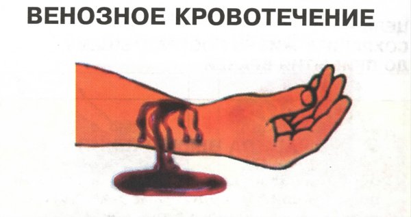 Как остановитьткровотечение