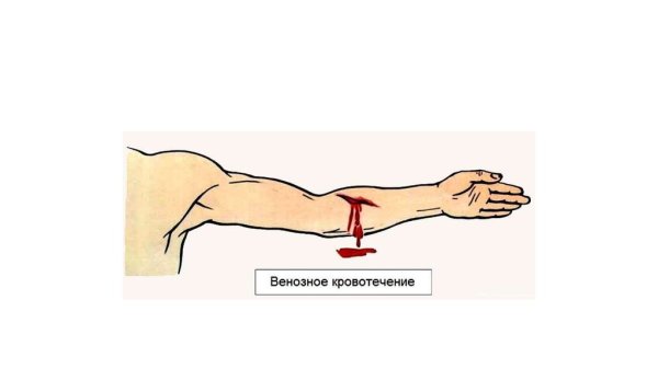 Артериальное кровотечение