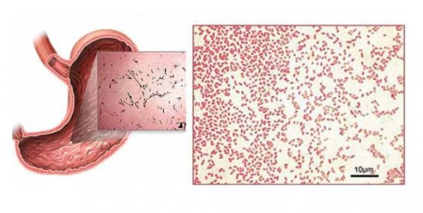 Shigella dysenteriae (шигелла дизентерия)