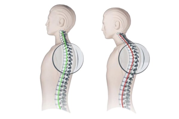 Кифоз шейно грудного отдела позвоночника