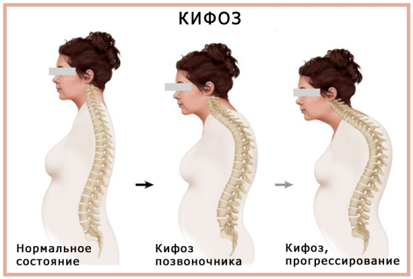 Кифоз позиционный м40
