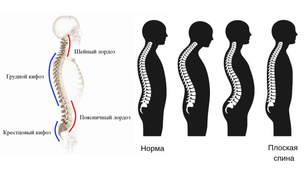 Шейный кифоз и поясничный лордоз
