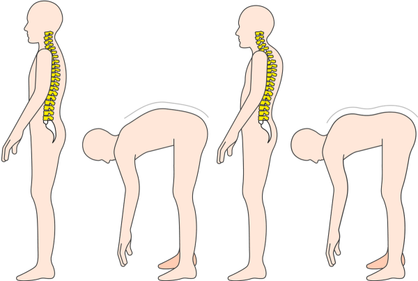 Кифоз грудного отдела позвоночника