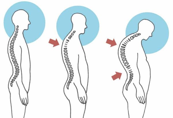 Искривление позвоночника кифоз