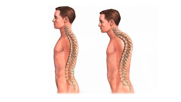 Кифоз грудного отдела и лордоз поясничного отдела