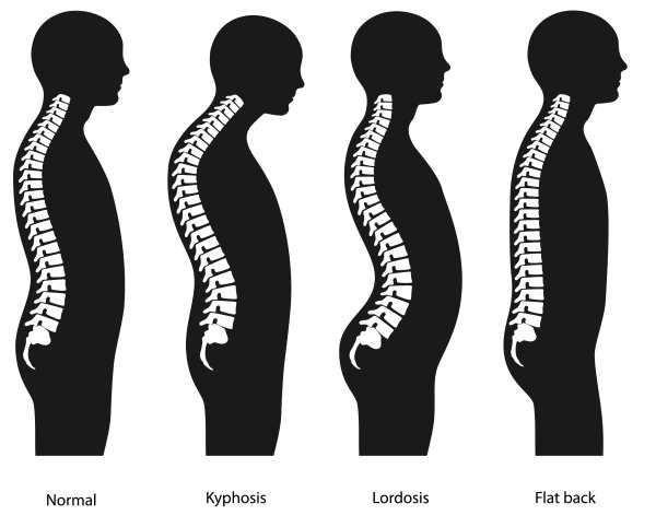 Кифоз лордоз и сколиоз позвоночника