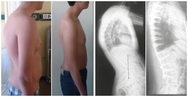 Кифосколиоз (болезнь Шейермана-МАУ)