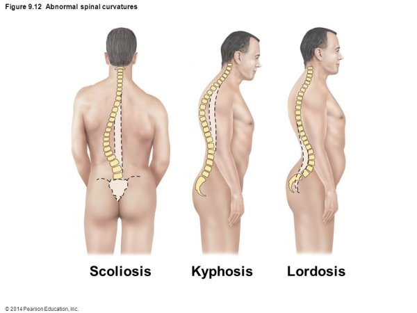 Кифоз лордоз и сколиоз позвоночника