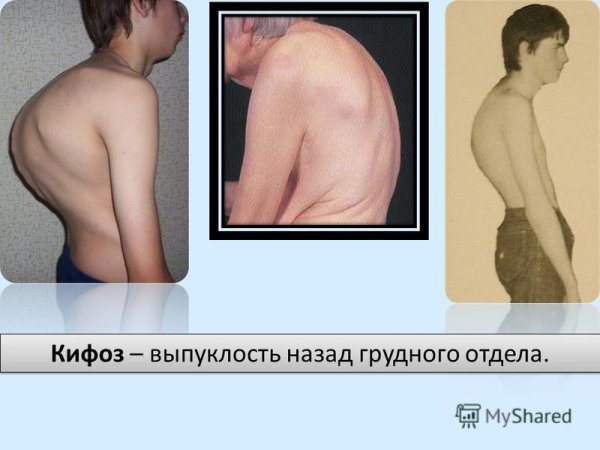 Грудной кифоз сглажен