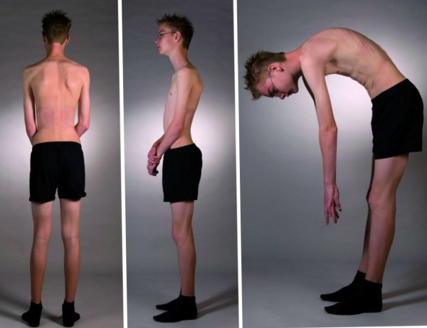 Кифоз грудного отдела позвоночника