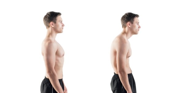 Бенедикт Магнуссон кифоз