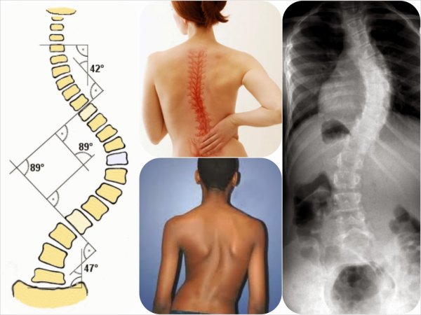 Функциональный кифоз