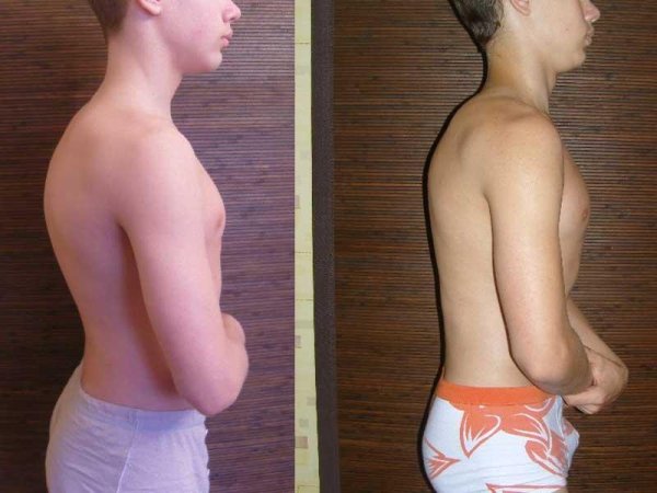 Кифоз грудного отдела позвоночника