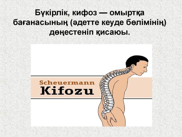 Кифоз это кратко