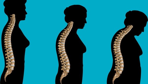 Угловой кифоз