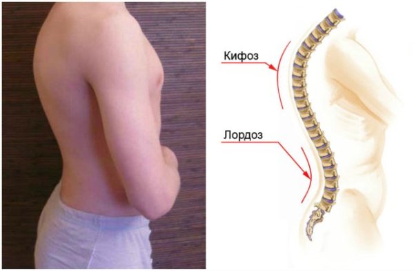 Лордоз грудного отдела кифоз поясничного