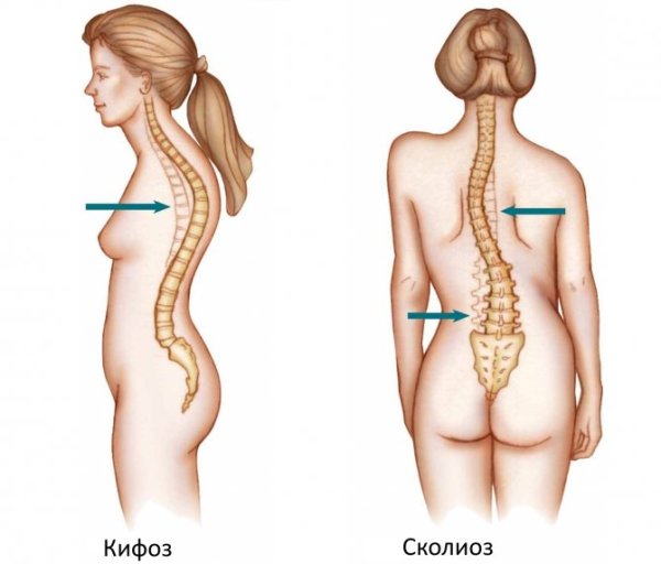 Сколиоз кифоз грудного отдела