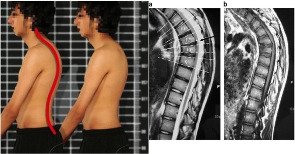 Кифоз грудного отдела болезнь Шейермана МАУ