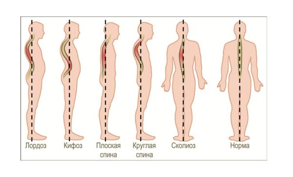 Кифоз поясничного отдела позвоночника