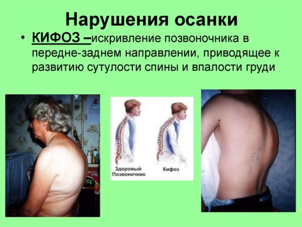 Деформации позвоночника ( сколиоз, лордоз, гиперкифоз)