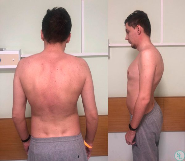 Степени сутулости спины