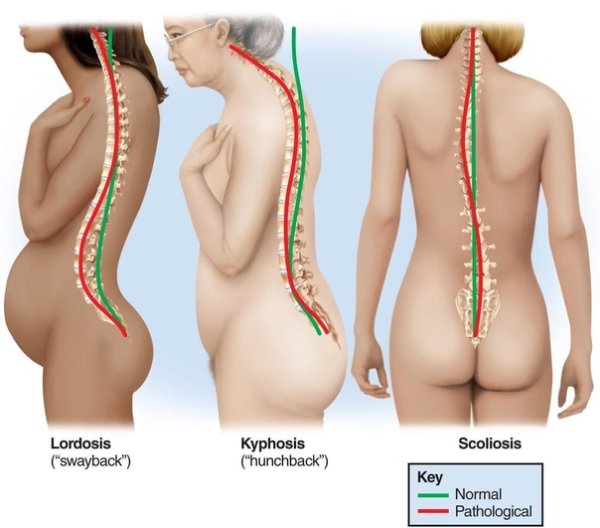 Гиперлордоз грудного отдела позвоночника
