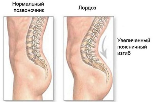 Диспластический кифоз грудного отдела позвоночника