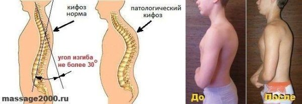 Искривление позвоночника кифоз