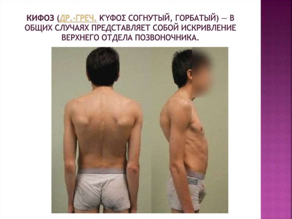 Остеопороз кифоз