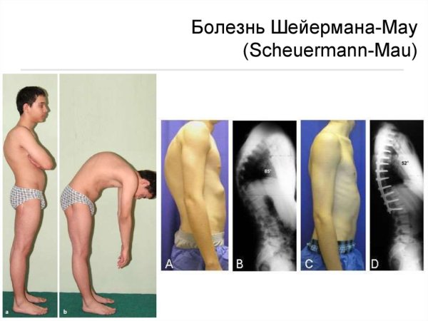 Искривление позвоночника болезнь Шейермана МАУ