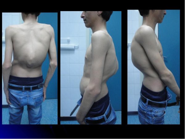 Кифоз лордоз грудного отдела позвоночника