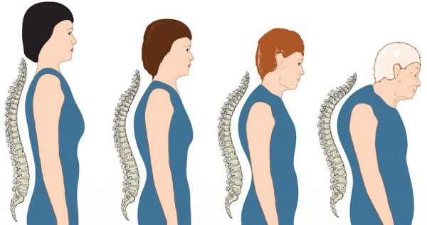 Кифоз грудного отдела позвоночника