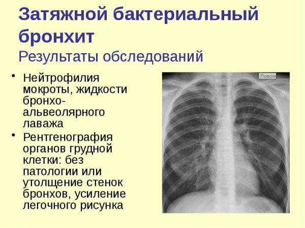 Ячеистое усиление легочного рисунка