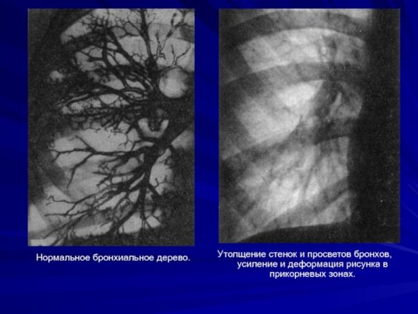 Пневмония стадия опеченения рентген