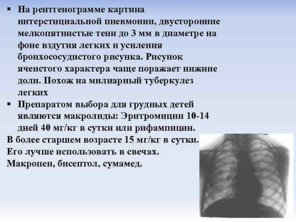 Легочный рисунок