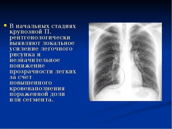 Усиление легочного рисунка