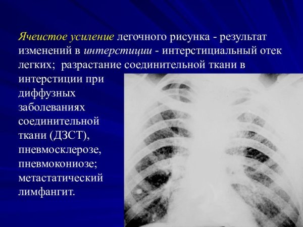 Училение лёгочного рисунка