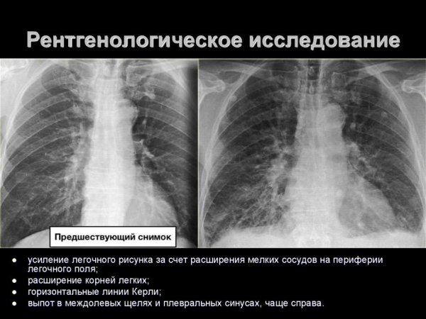 Микоплазменная пневмония рентген